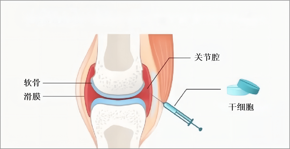 干细胞治疗骨关节炎,安全有效!_疾病_患者_损伤