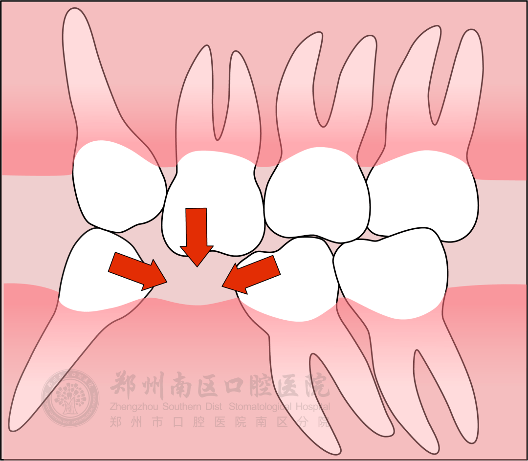 咬合_牙齿_种植体