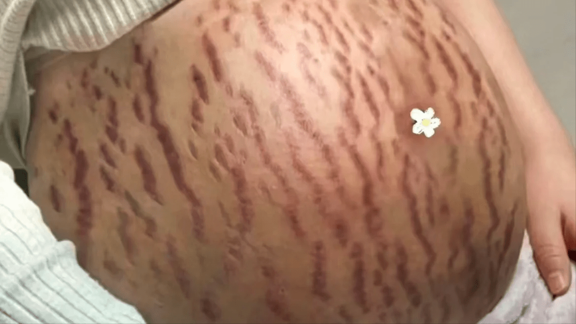 妊娠纹是很多宝妈面临的普遍问题,其主要原因是由于怀孕期间皮肤的