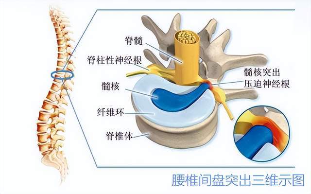 腰间盘突出骨骼示意图图片