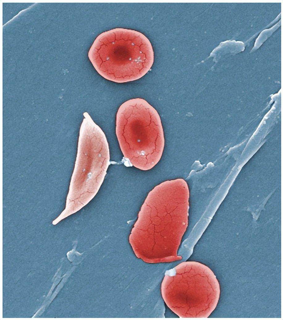 新月形红细胞图片图片