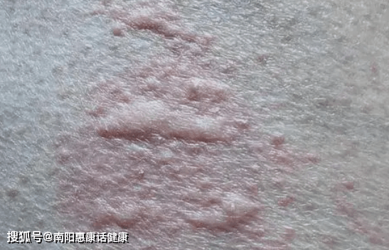 荨麻疹的典型症状,是否能治愈?【南阳惠康】解答