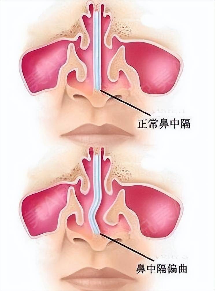 鼻中隔偏图片