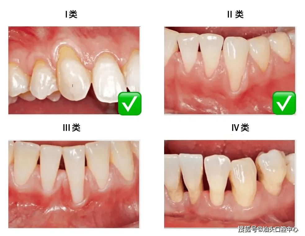 牙龈萎缩程度图片图片