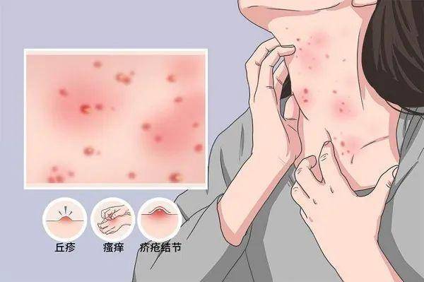 治疗疥疮最快的方法,该怎么选择产品?_患者_疥虫_消毒