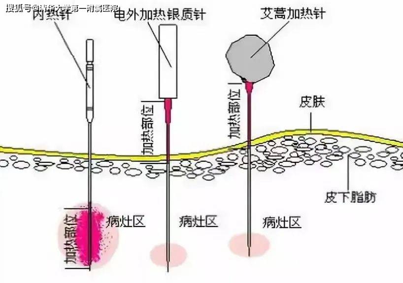 缓解颈肩腰腿痛的利器——清华一附院麻醉科疼痛专业组开展内热针导热