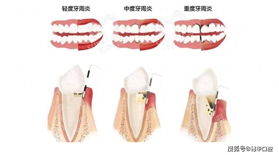 30歲重度牙周炎,還能治好嗎?_牙齒_牙縫_嚴重