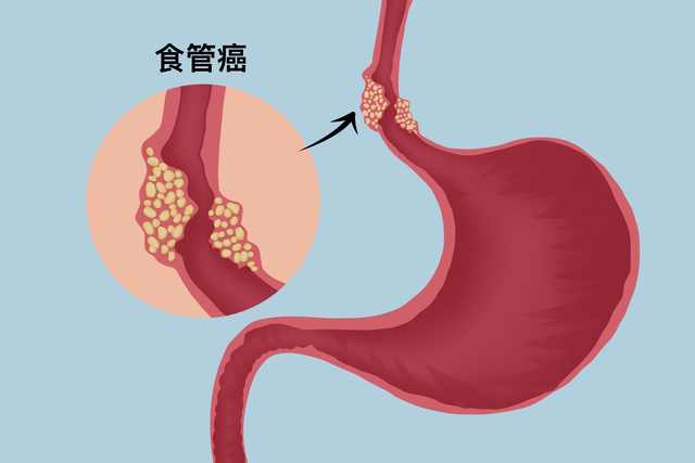 喉嚨痛和聲音變化:當食管癌擴散到喉嚨附近時,患者可能會感到喉嚨