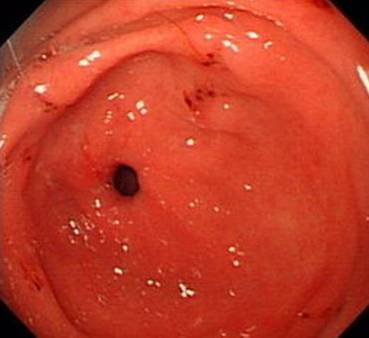 糜烂性胃炎报告单图片图片
