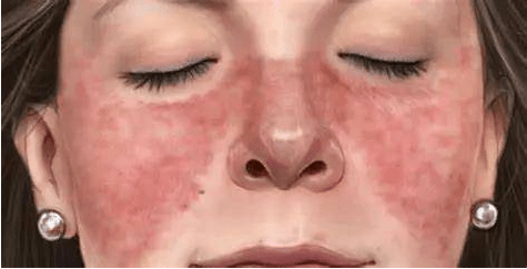 红斑狼疮是什么病?_问题_患者_控制