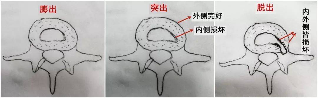 別不當回事,真相很殘酷_纖維_腰椎_脊柱