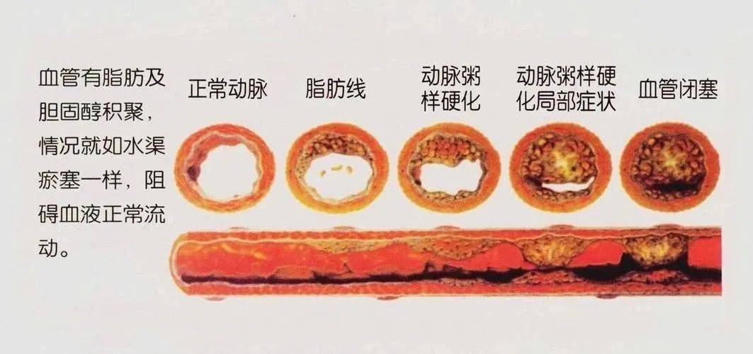 幹細胞可調節血脂水平,修復血管損傷,降低動脈粥樣硬化風險_疾病_斑塊