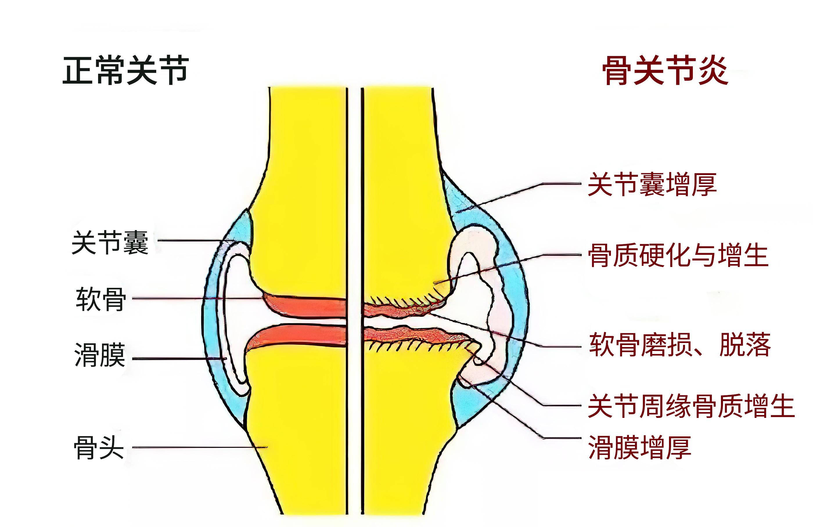 哪些人容易患上膝骨关节炎?除了中老年人,还有4种人要警惕!