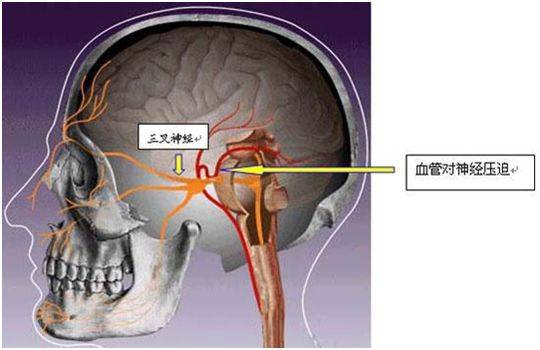 王晓松:面部持续疼痛警惕三叉神经病变_患者_客户_感觉