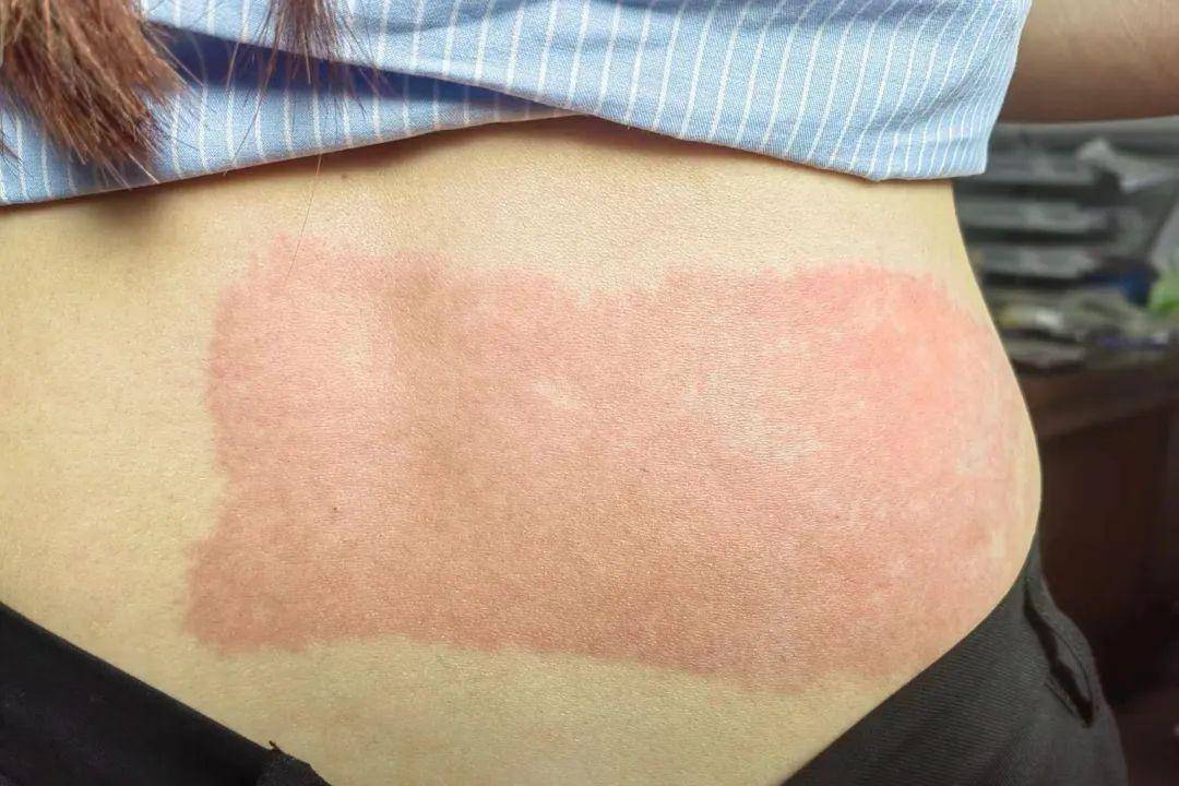 低温烫伤,和"温水煮青蛙"郑州颐和医院医生指出,却能把身