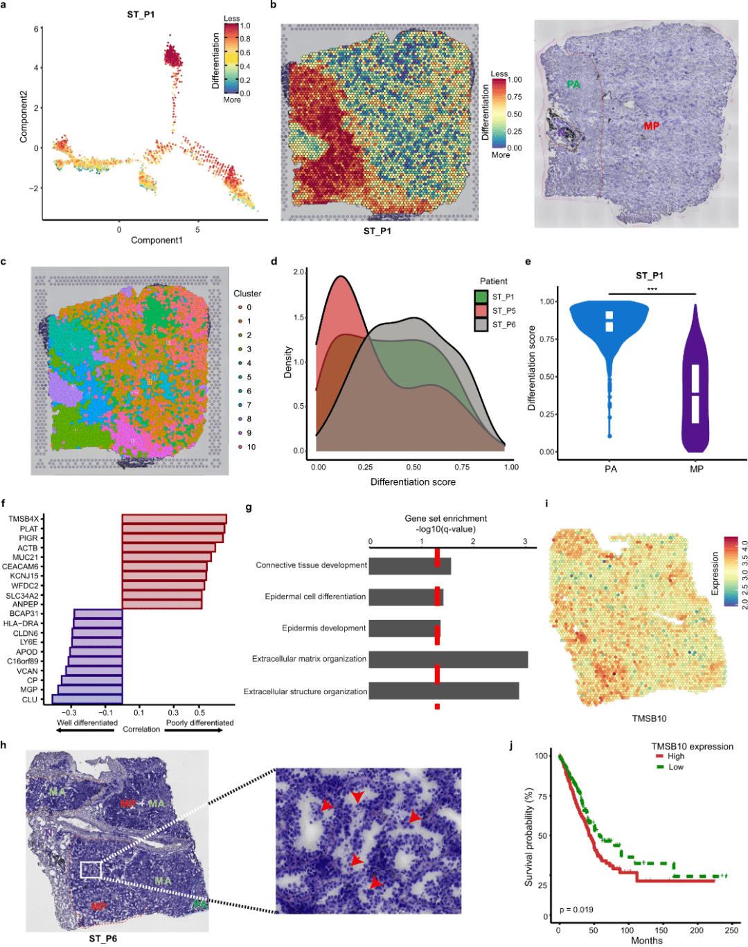 cell discov| 北京大學利用空間多組學揭示肺腺癌進展中分子亞型及細