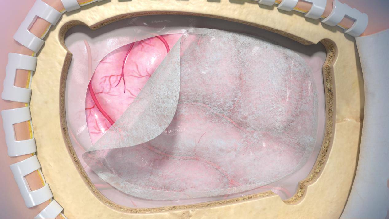 图为:硬脑(脊)膜修补片临床应用示意动画图为:腹股沟疝生物补片临床