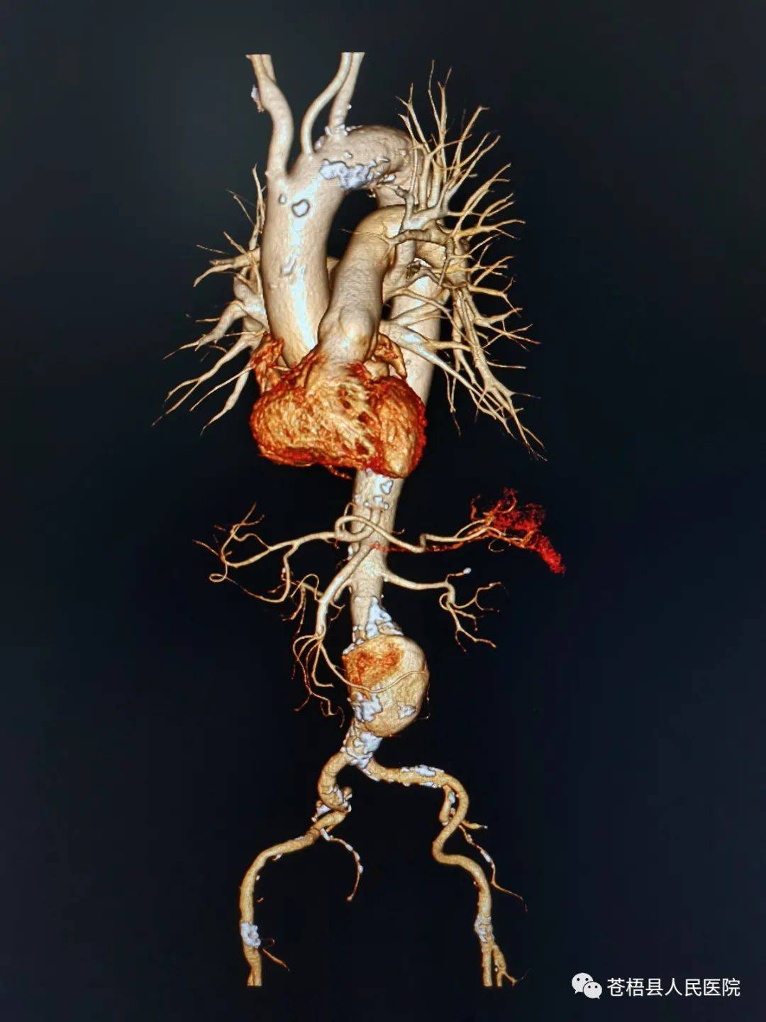 血栓形成的高危患者行下腔静脉滤器置入术患者从高处坠落致脾动脉破裂