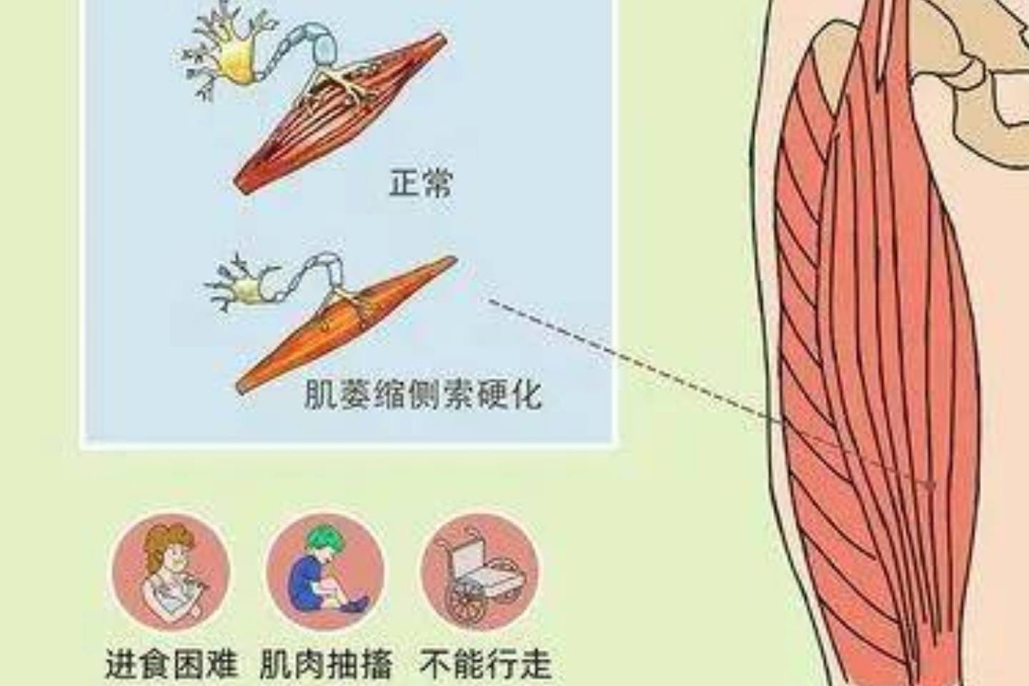 科普运动神经元小知识_患者_肌肉_进行性