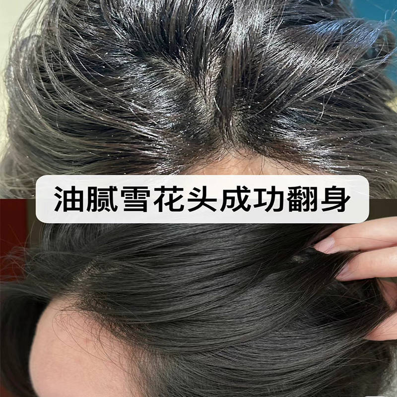 用醋洗头可以止痒去屑吗?止痒去油洗发水推荐