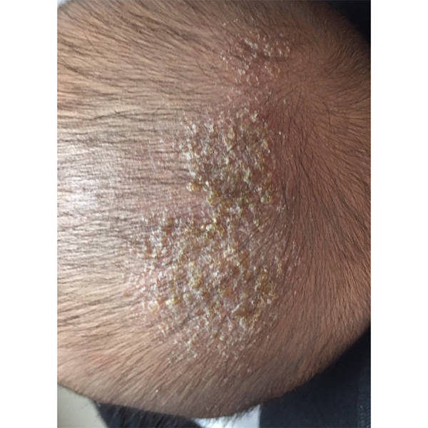 头皮痒用什么洗发水效果好?去屑控油洗发水品牌排行榜前十名