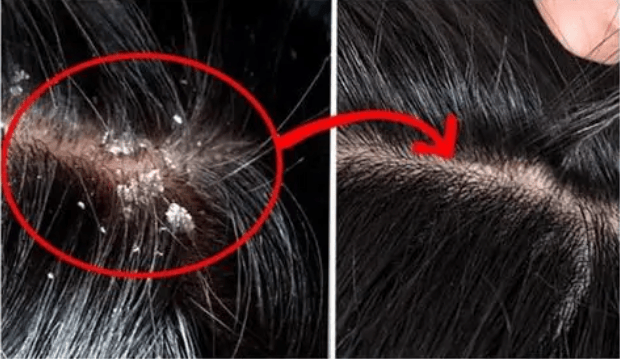 用啥洗发水去头皮屑?好用的洗发水去屑推荐