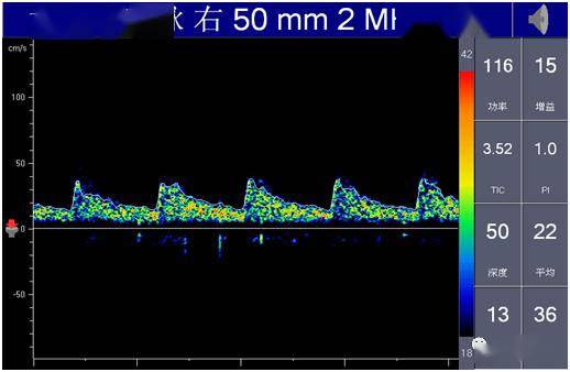 你所不知道的经颅多普勒6异常血流频谱之流速减慢及其他