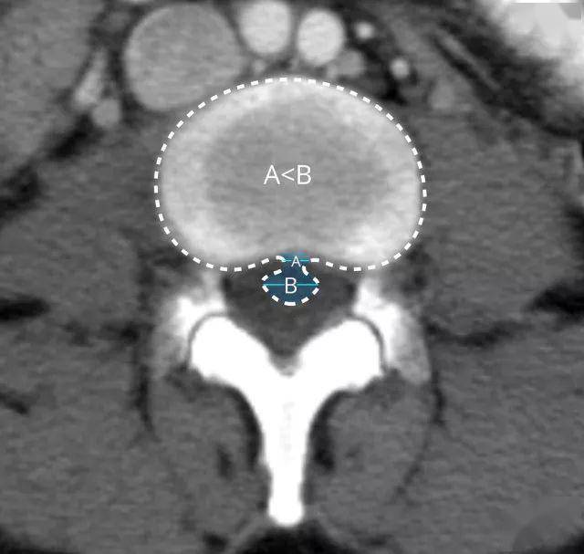 椎间盘膨出影像图片