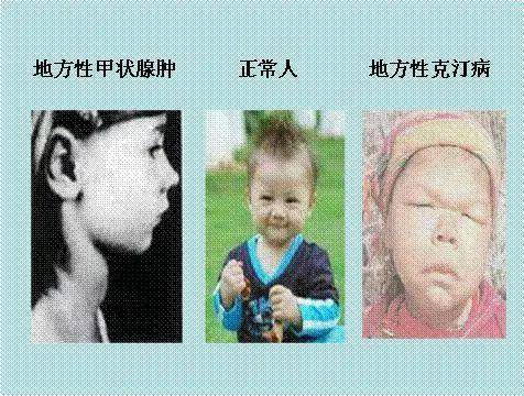 严重的造成克汀病,聋哑,智力损伤等会影响大脑正常发育如果孩子在胎儿