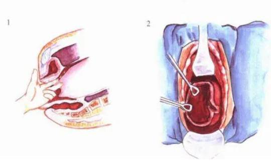 宫颈裂伤分度及示意图图片
