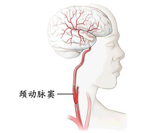 按压颈静脉窦的位置图图片