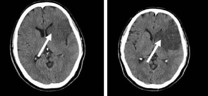 掌握5个征象ct也能诊断超早期脑梗死
