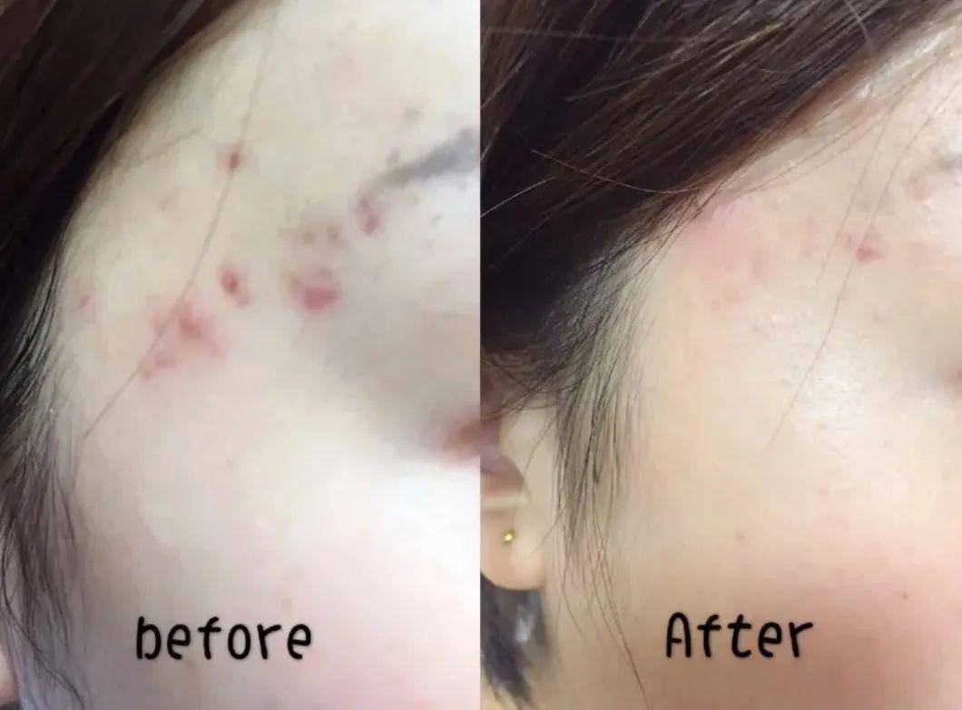 刷酸后长了鸡皮疙瘩(刷酸以后皮肤变粗糙小疙瘩)