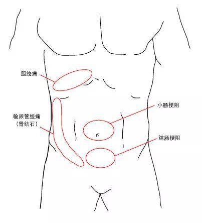bmj evidence centre制作 上腹部疼痛可能与消化性溃疡/穿孔,胰腺炎