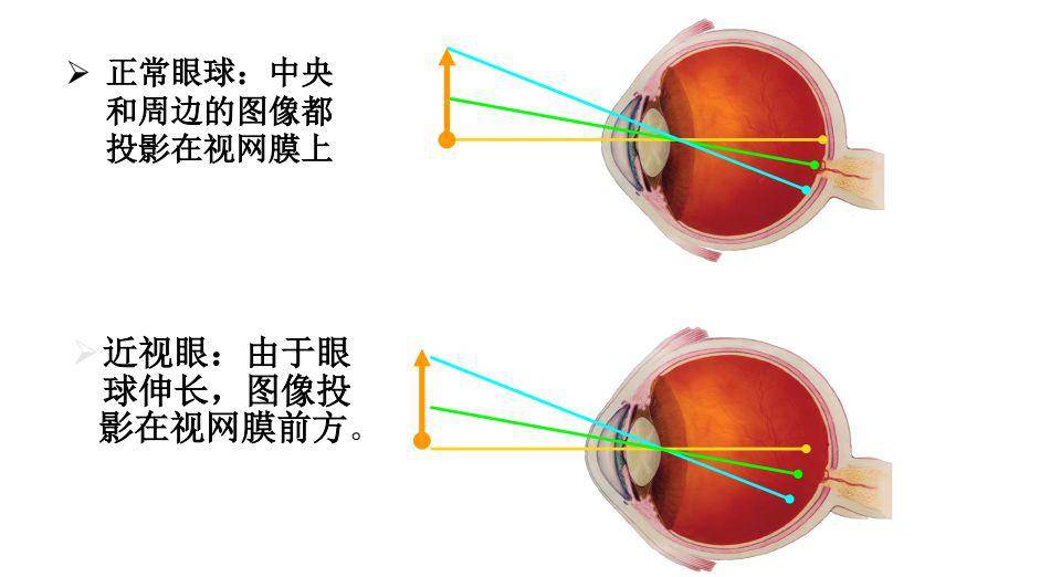 控制近视新突破可控59到底是什么产品