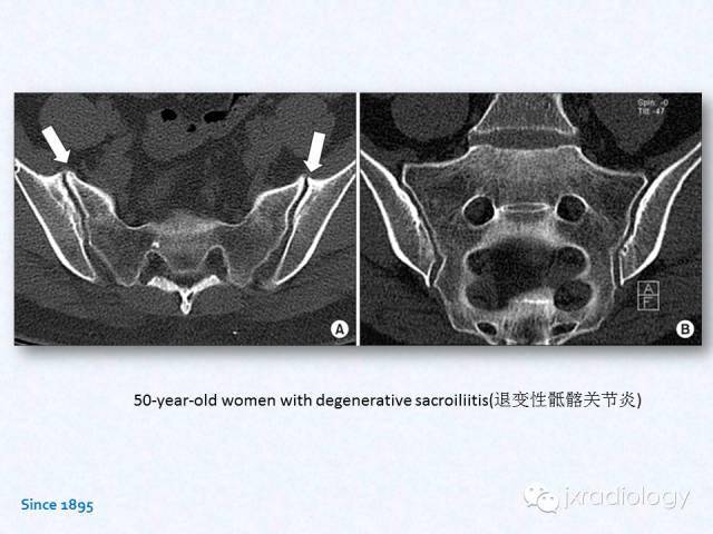 骶髂关节炎:x线,ct和mri表现