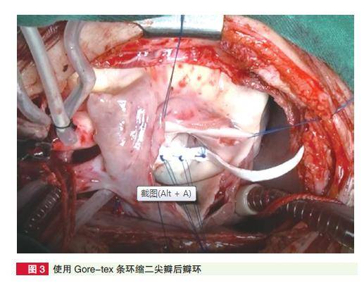 【解析】自创"三步法"二尖瓣成形术安全有效,阜外医院李守军等分享70
