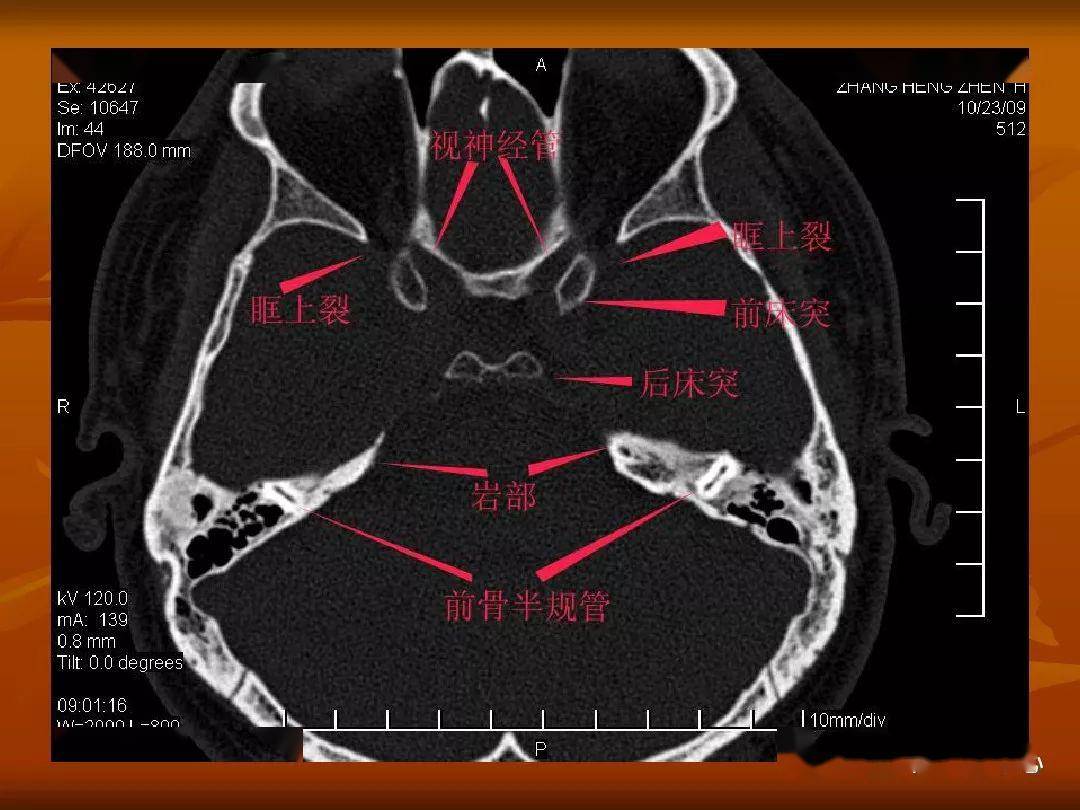 颅骨外伤性骨折ct诊断