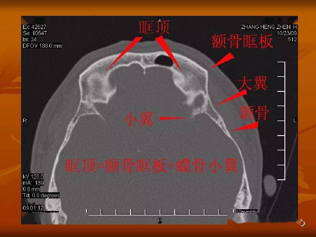 颅骨外伤性骨折ct诊断