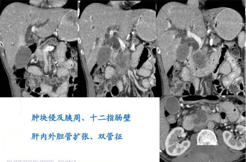 壶腹癌影像表现及鉴别诊断_手机搜狐网