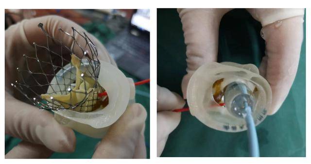 江西首例!3d打印技术换心脏瓣膜 更加精准
