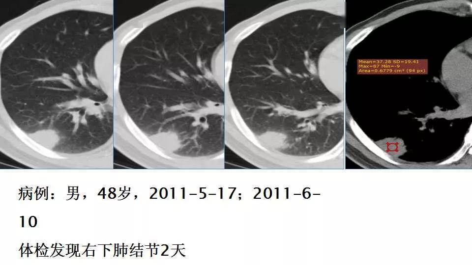 小结:mr成像,t2w中等信号,似有环dwi成像,低信号,adc值偏高dce-mei