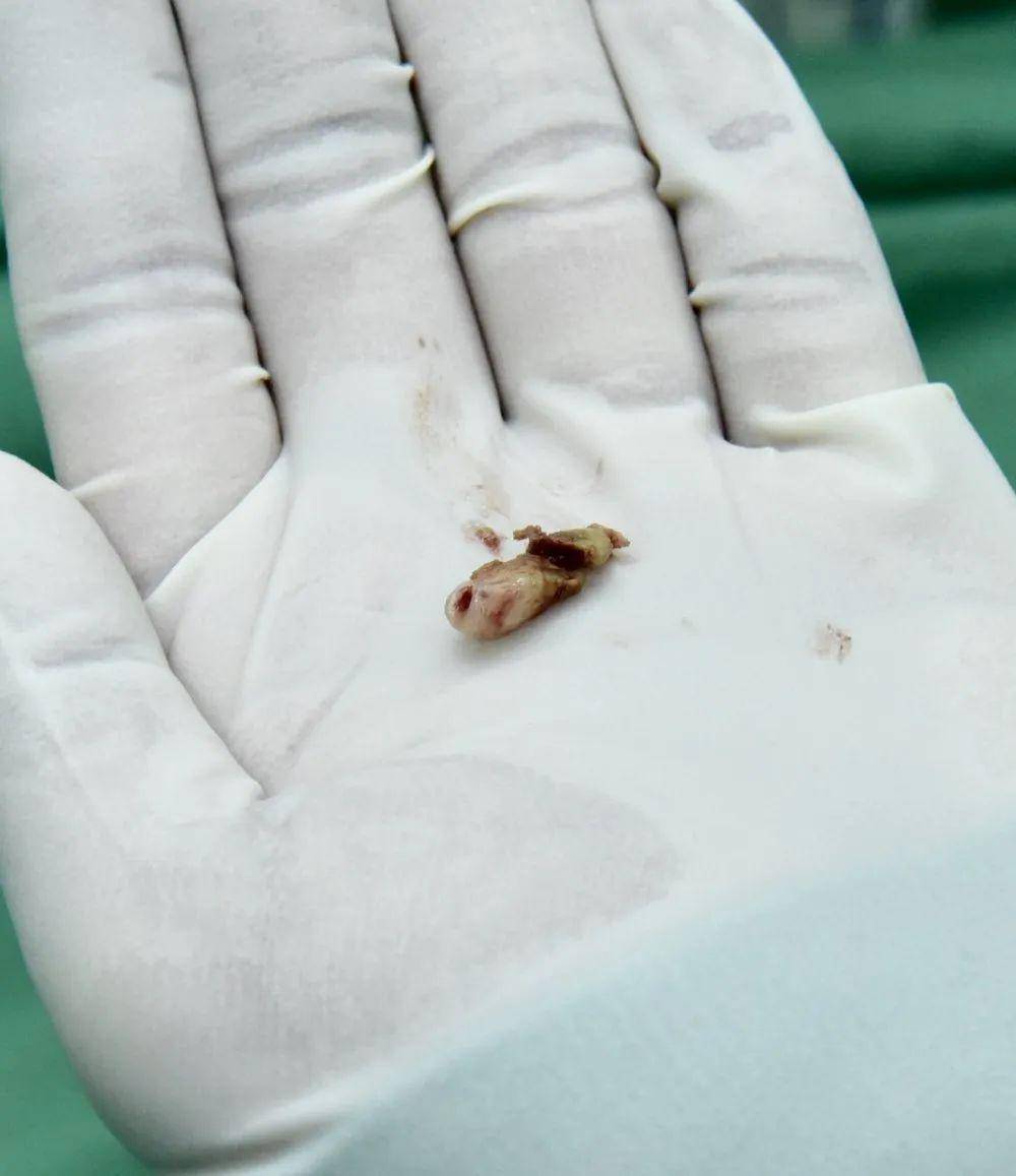 昊昊的鼻子总是臭臭的,原来是它在作怪!_鼻孔