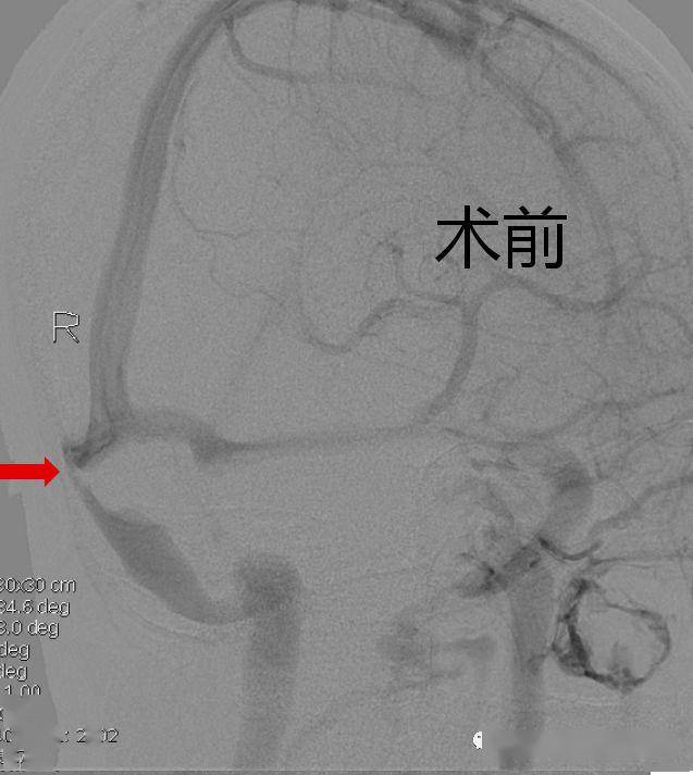 介入治療科王峰主任率領的介入團隊反覆評估患者腦血管解剖,手術入路