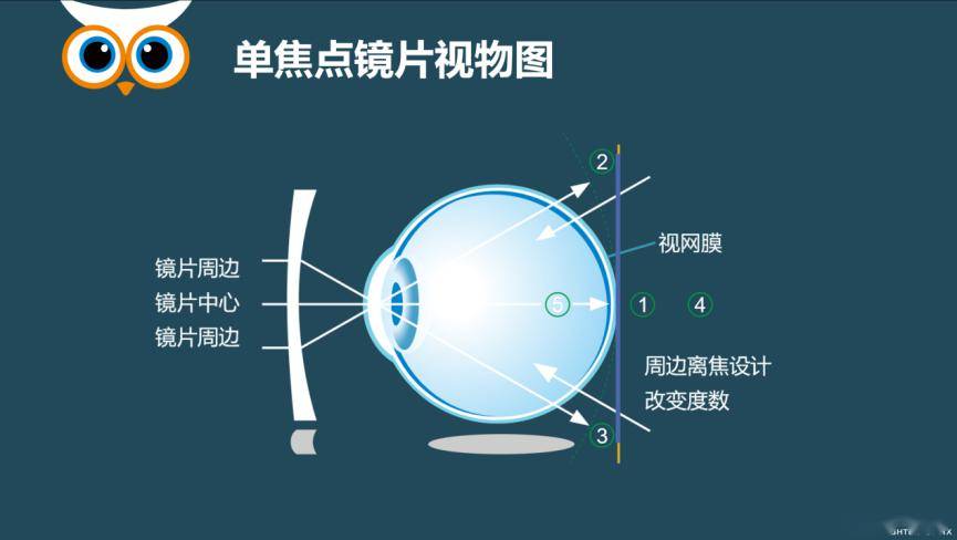 近视防控新进展贝视得近视管控镜片的设计原理和最新临床研究