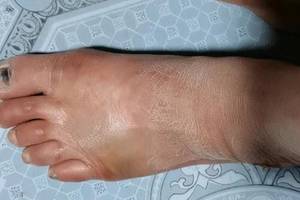 脚背被石头砸到,立马肿了起来!