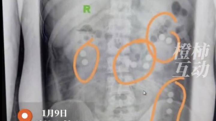 19岁小伙腰痛拍片肠胃里全是奶茶珍珠，你觉得有科学依据吗？