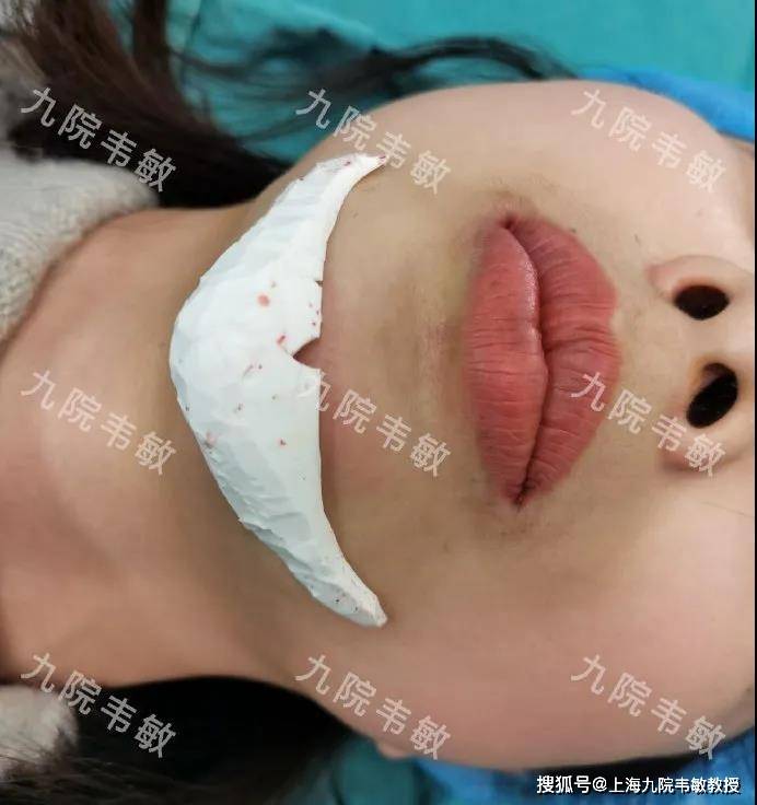 九院韦敏教授丨臃肿的硅胶下巴假体成功取出