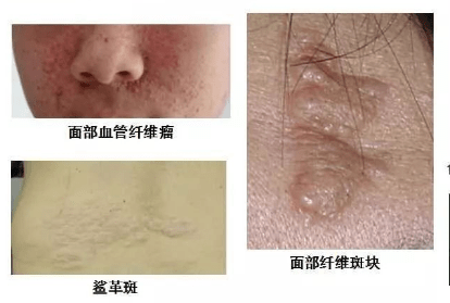 结节性硬化症状调查中医理论中医怎么调理结节性硬化症