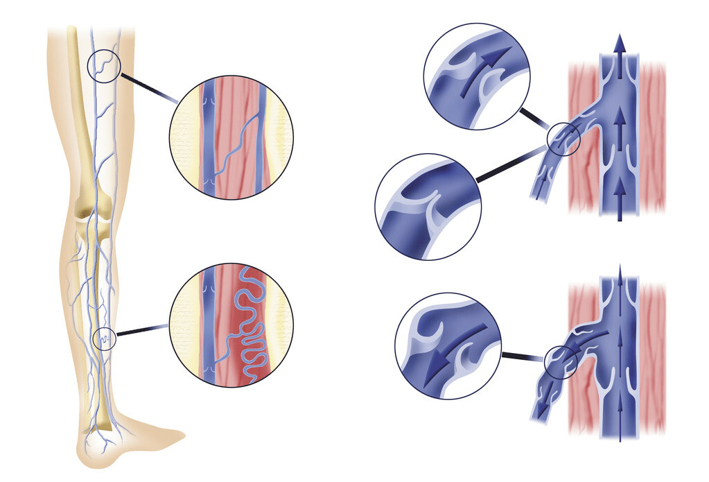 静脉瓣膜功能出现问题,有可能是患者先天就有问题,也可能是患有静脉